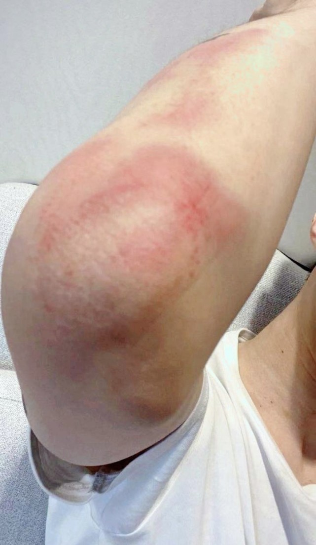 从机场饭拍图也可以看到胳膊的红肿8915(cr@fantastic baby