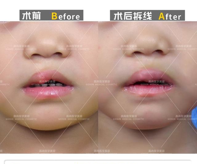 像这位小女孩的问题就是唇裂术后唇红局部肥大,只需要进行红唇修复,让