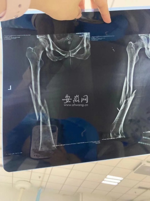 图为:王女士向记者提供的ct图