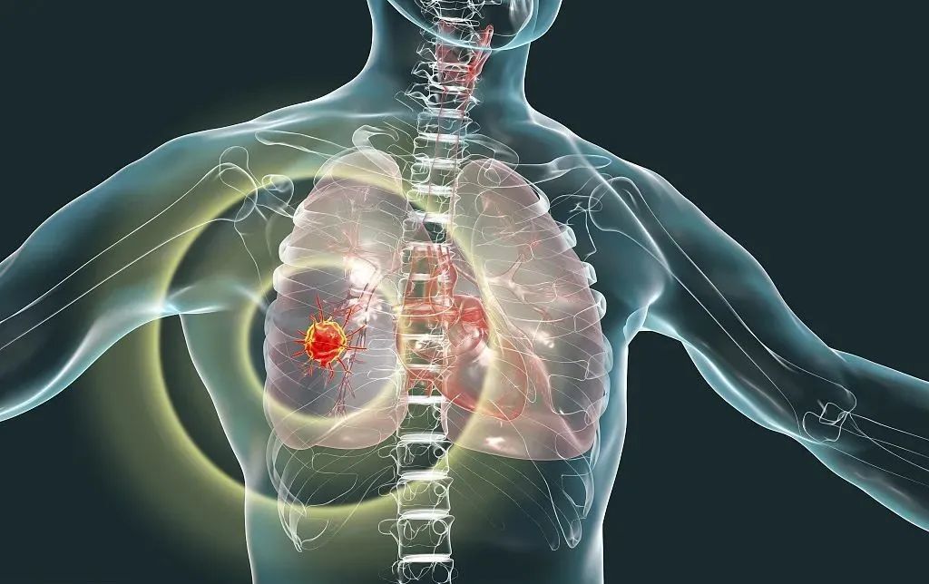 肺癌疼痛的位置图图片