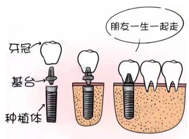 這幾類人不適合做種植牙!一定要知悉