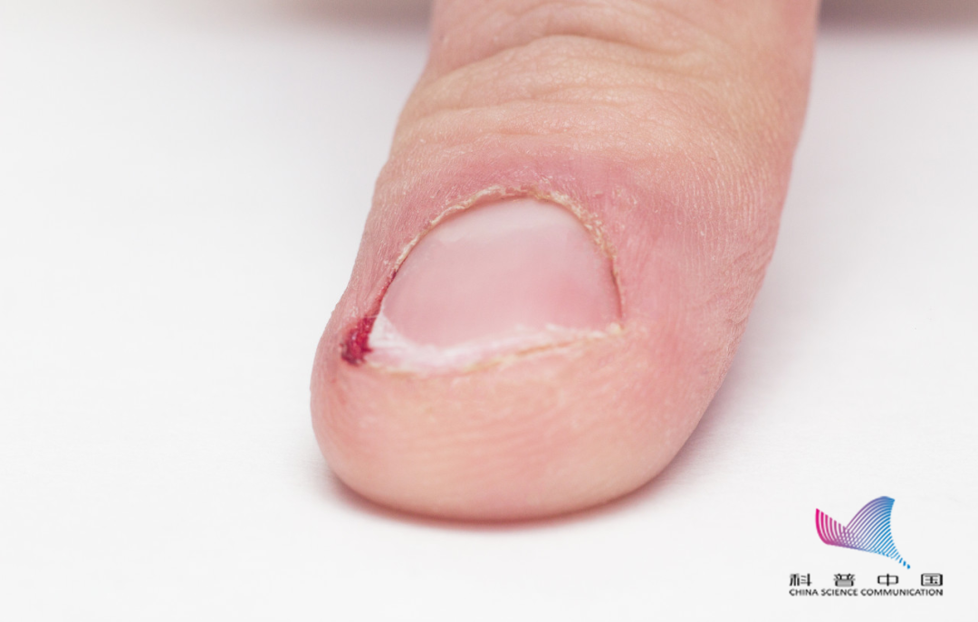 快住手千万别随便拔手上的倒刺有人因此住院