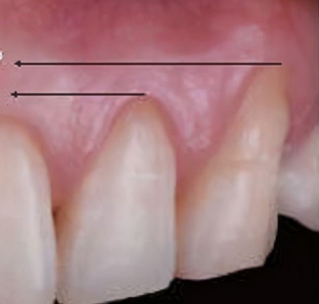 随着年龄的增长我们的牙龈也会或多或少发生萎缩,使牙根暴露这是正常