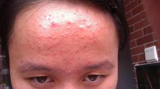 刷酸等于换脸心动尝试之前你一定要知道这些