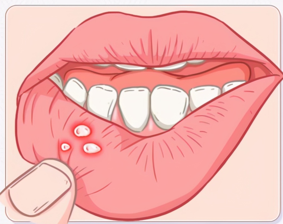 预防口腔溃疡,可以从这5个方面入手!__凤凰网