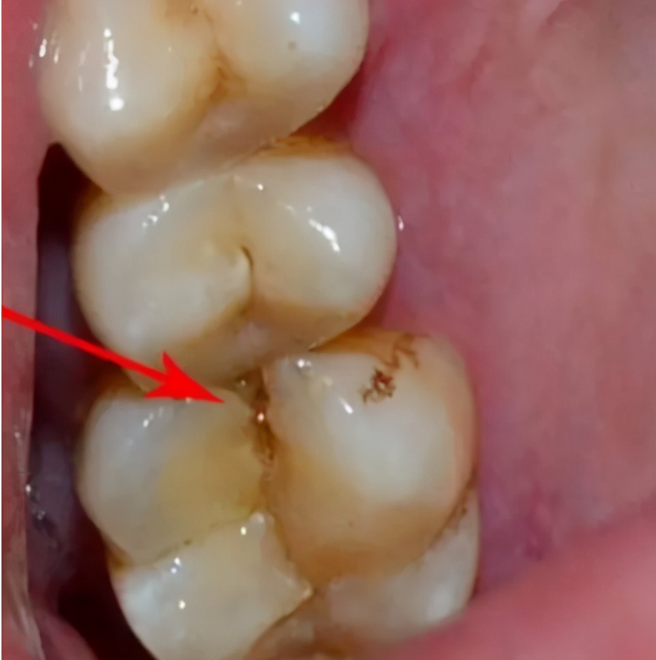 若出现这6种牙疼不及时治疗那你的牙齿可就不保了