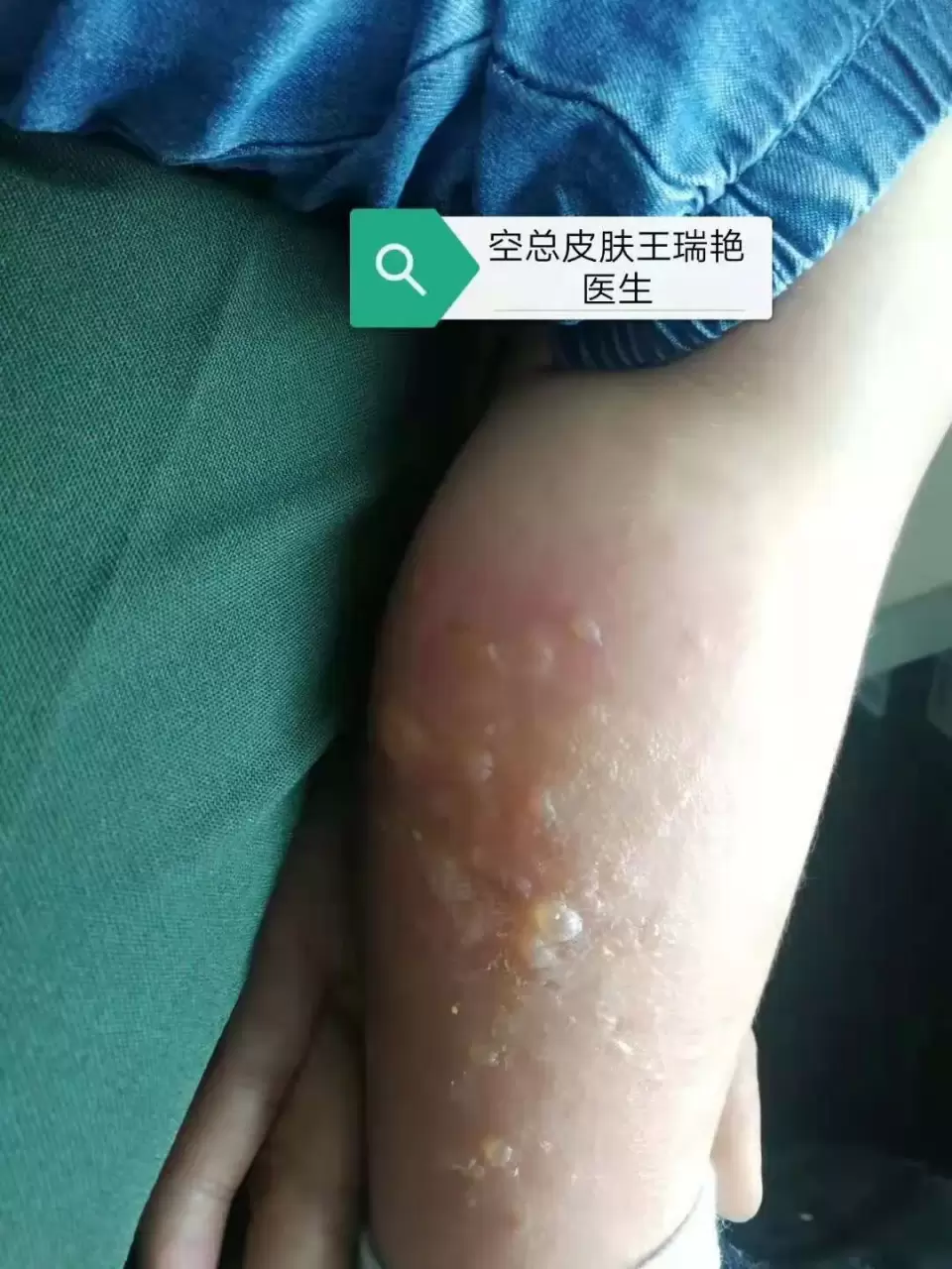 花柳是什么症状图片 搜狗图片搜索 花柳是什么症状图片 搜狗图片搜索