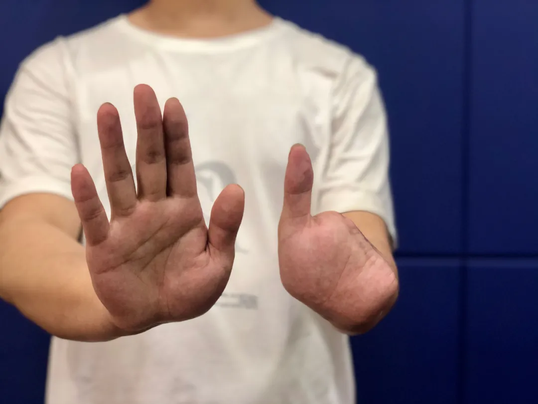 一小伙去趟境外,结果4根手指没了……__凤凰网