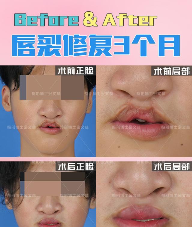 那怎样的唇裂修复才算一次成功的修复呢?