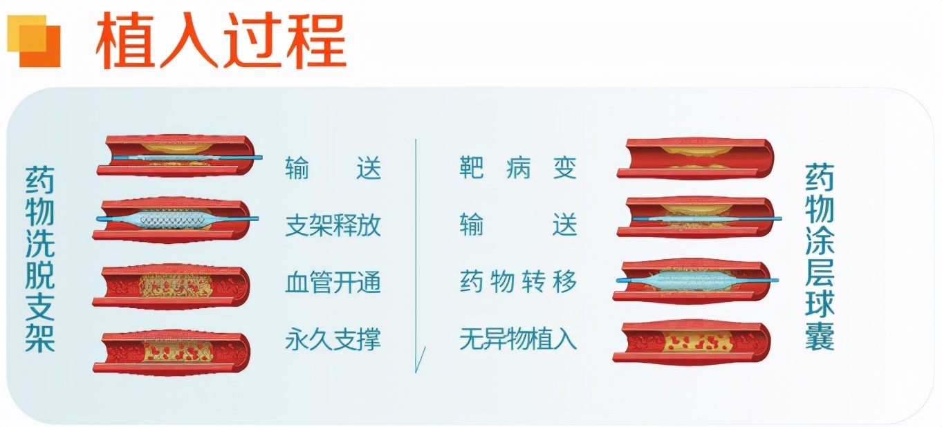 冠脉药物球囊——诠释冠心病治疗"介入无植入"新理念__凤凰网
