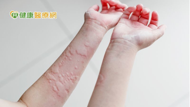 慢性荨麻疹治不好 反复发作可考虑生物制剂__凤凰网