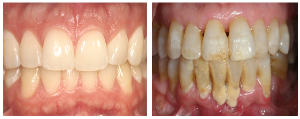 健康牙龈(左)与牙周炎患者牙龈(右)丨uptodate