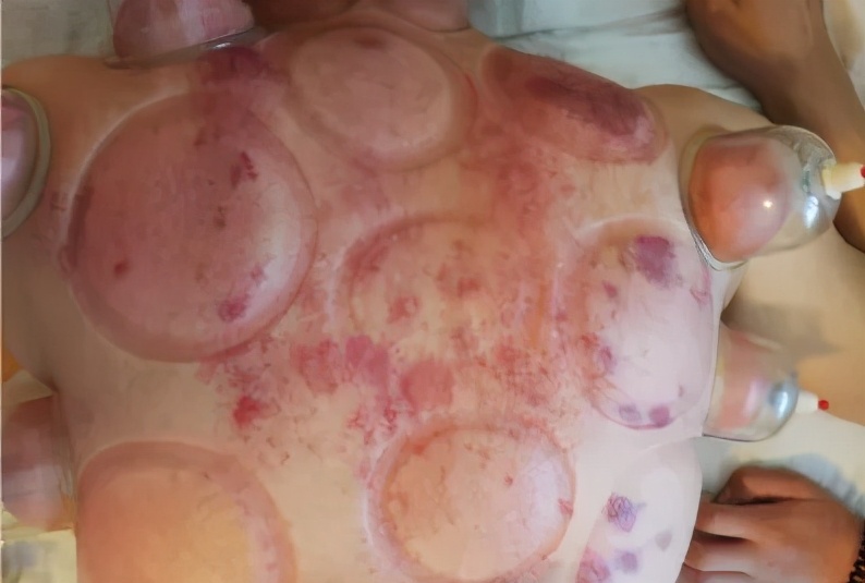 拔罐拔出果冻状物质你见过吗?