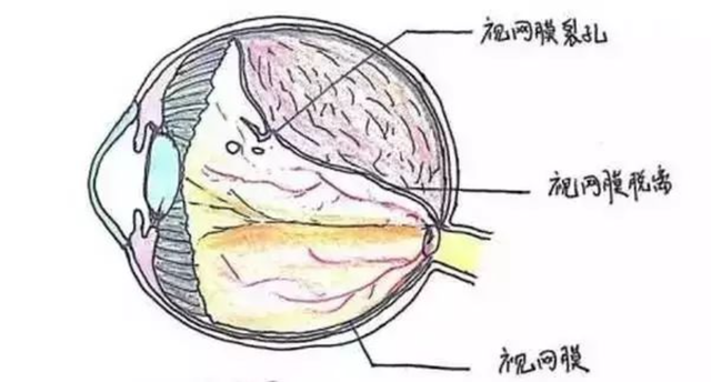 顧名思義,很好理解,其實它就是視網膜神經上皮層從其所粘附的眼球壁上