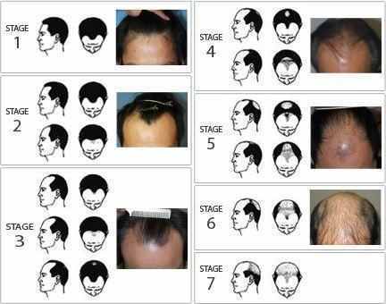 脂溢性脱发逐渐发展的过程,脂溢性脱发的特点有哪些