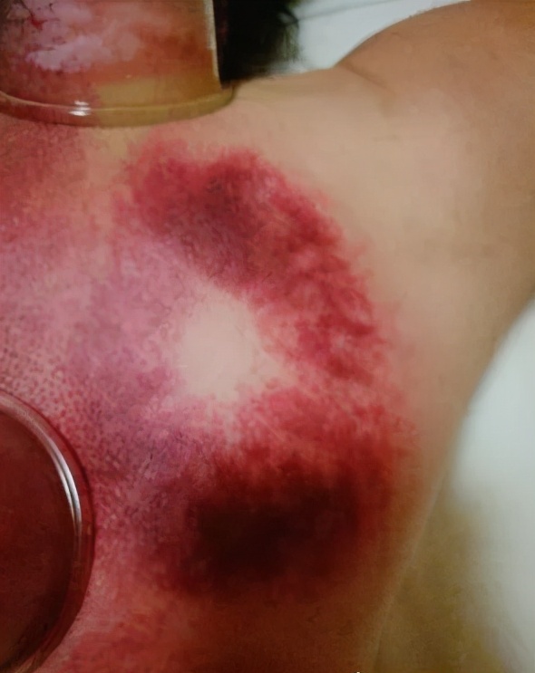 拔罐拔出果冻状物质你见过吗?__凤凰网