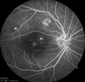 沃丽汀|中浆病难治吗?眼科医生为你深度分析