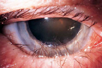 年纪大的人为什么总觉得眼睛里"磨"得慌,有异物感?__凤凰网