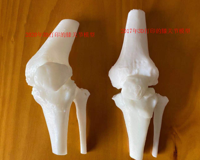 苏州明基医院成功为一位生长发育障碍患者"私人定制"人工膝关节