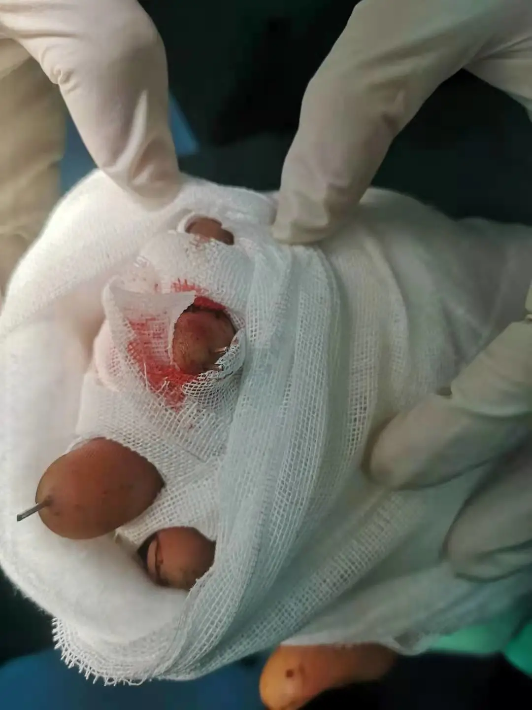 惊魂!电锯切掉3根手指,医生奋战十小时