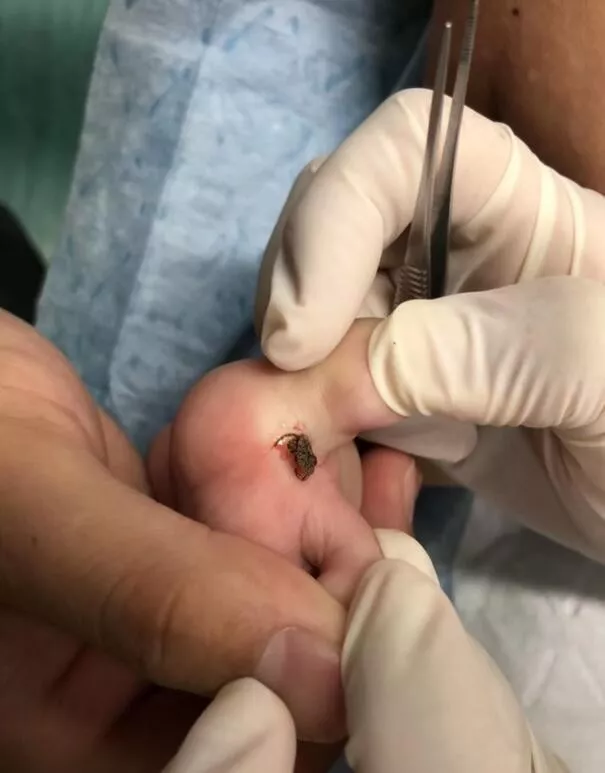 吓人!妈妈随手一拍,3岁孩子溃烂了半张脸:夏日防虫千万要小心