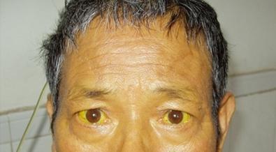 肝脏求救信号之"皮肤篇",医生:每出现一个,病情就加重一分__凤凰网