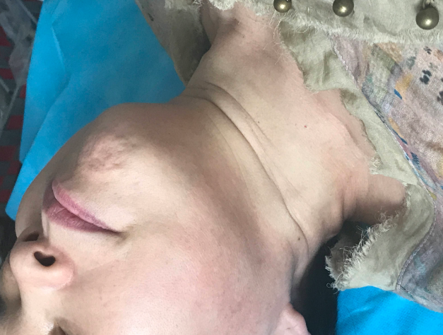 遗传性颈纹应该如何治疗