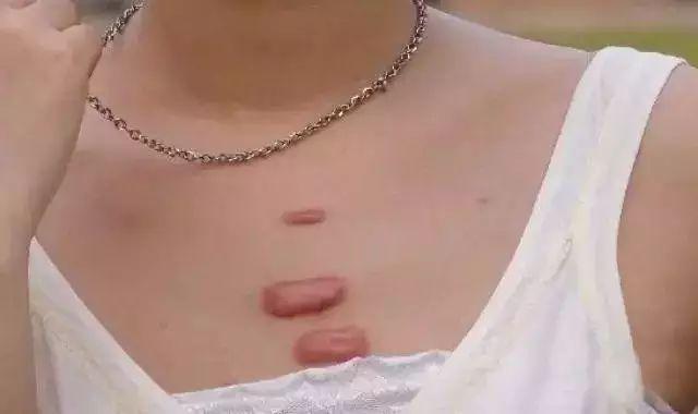 疤痕体质平常要注意哪些?增生性疤痕一般需要多久才能变平呢?