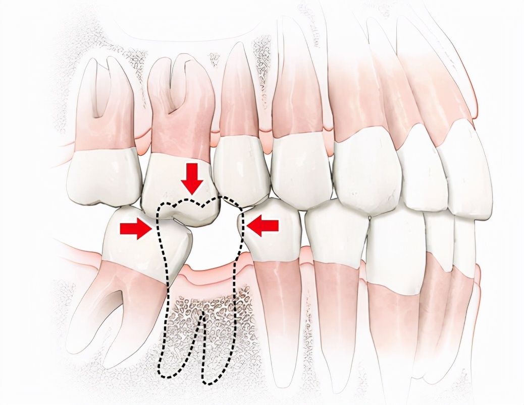 這樣會給之後的牙齒修復帶來巨大困難, 還會造成食物嵌塞,引發牙周病
