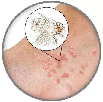 因疥虫活动主要集中在晚上,所以有疥疮的人的晚上瘙痒感受更为明显.