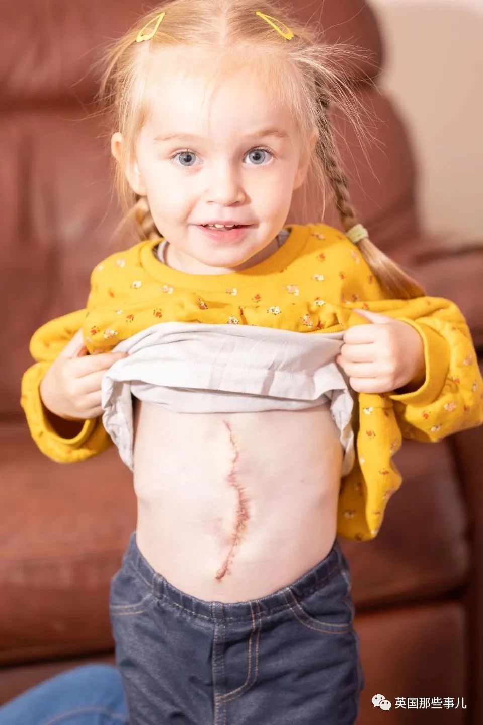 小女孩腹部手术图片