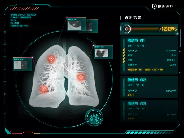 贵港市人民医院引进肺结节人工智能(AI)软件,肺结节无处藏身