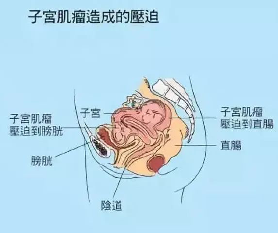 得了子宮肌瘤不用過分緊張 來看看專家是怎麼說的吧