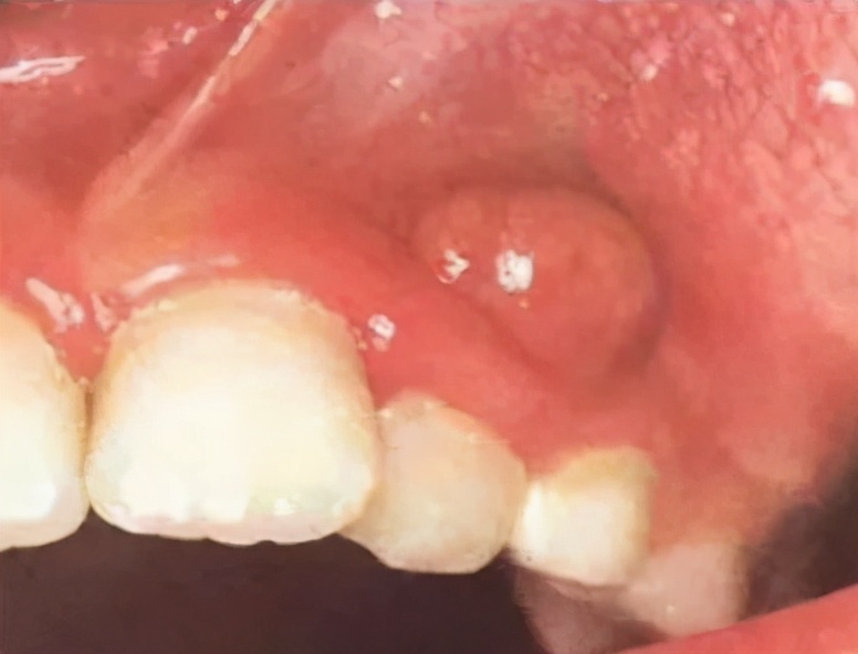 蛀牙治疗不及时可能会导致根尖周囊肿