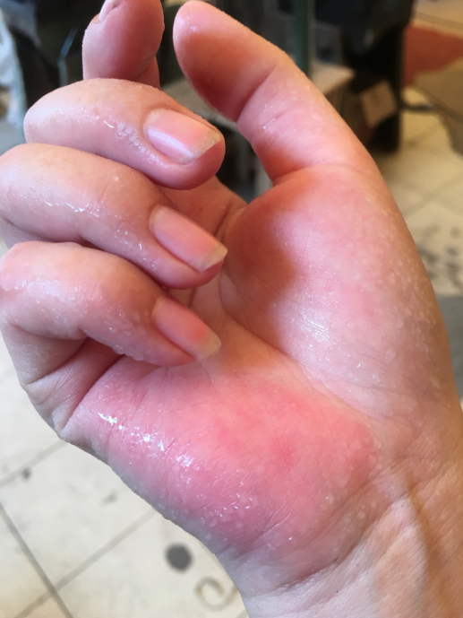 67张先生长大之后,也到了谈恋爱的年纪,可这手汗的症状却从未减轻