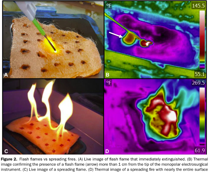 为什么手术用电刀患者痔疮手术中放了个屁，居然引发一场火灾_https://www.jmylbn.com_新闻资讯_第4张