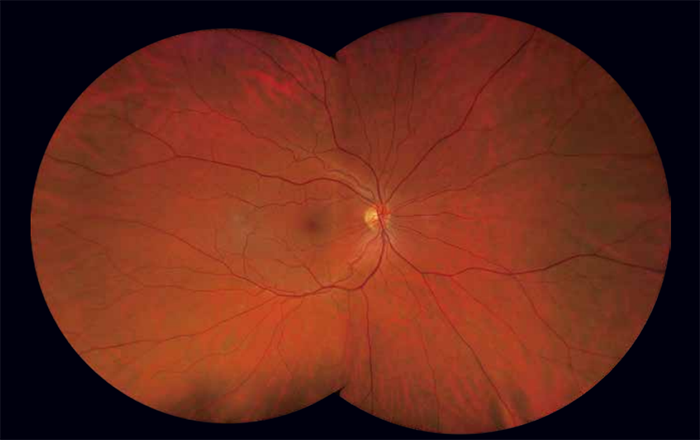 重要,德国蔡司clarus 500超广角眼底照相机生成彩照的波长>200超广角