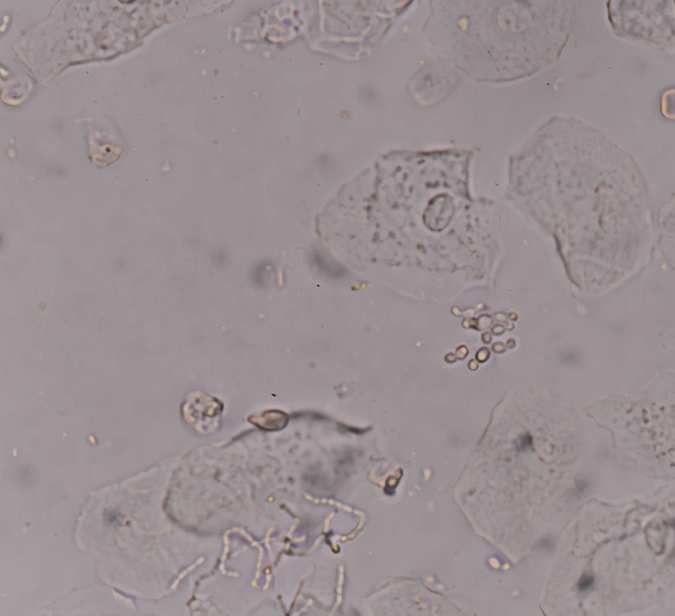 白带霉菌孢子镜下形态图片