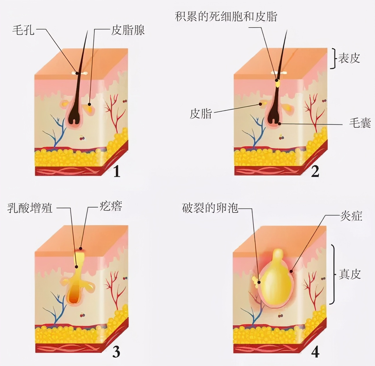 杭州微针祛痘 | 什么是微针?微针祛痘是什么原理?__凤凰网