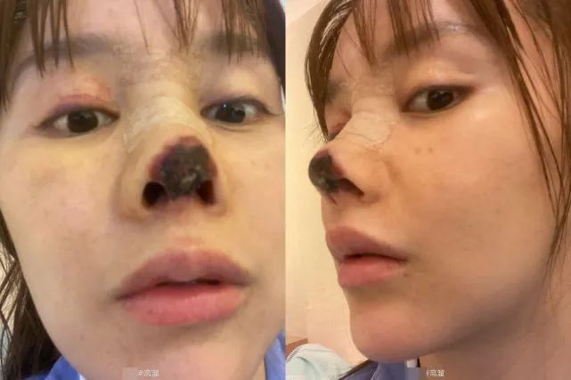 在广州南方医院的入院记录显示:该医院门诊检查后,以隆鼻术后鼻畸形