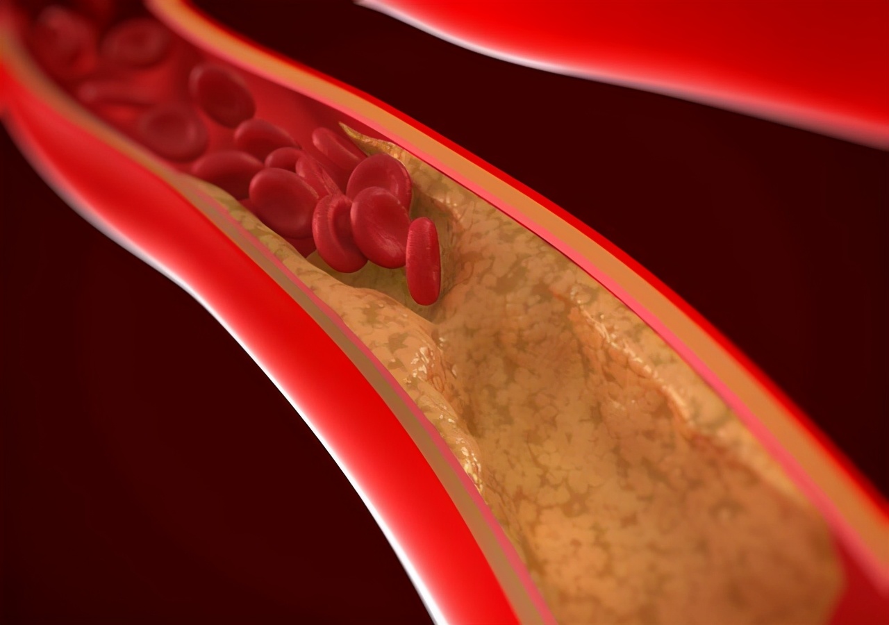 血管堵塞的人,晨起有3处异常,一个都没有,恭喜血管保养得很好__凤凰网