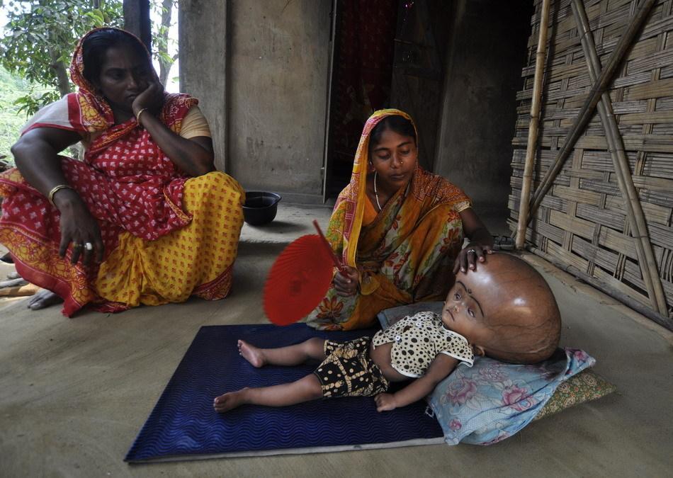 印度女孩脑积水,94厘米的头围像"外星人",五岁半还无法说话