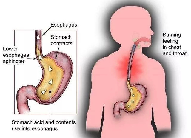 反流性食管炎为什么难以治愈?原来导致它难以治愈的原因在这里!