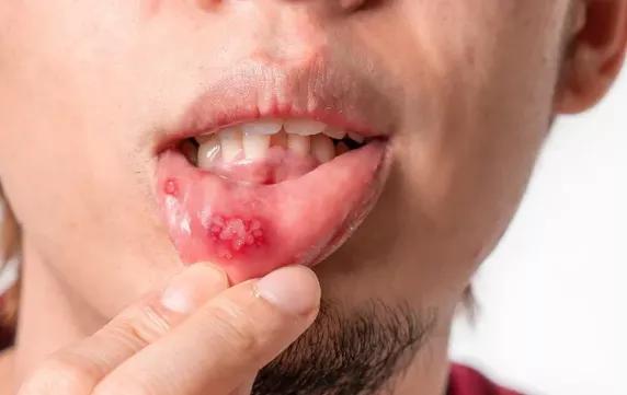 有一种痛叫口腔溃疡 ,这些办法快试试