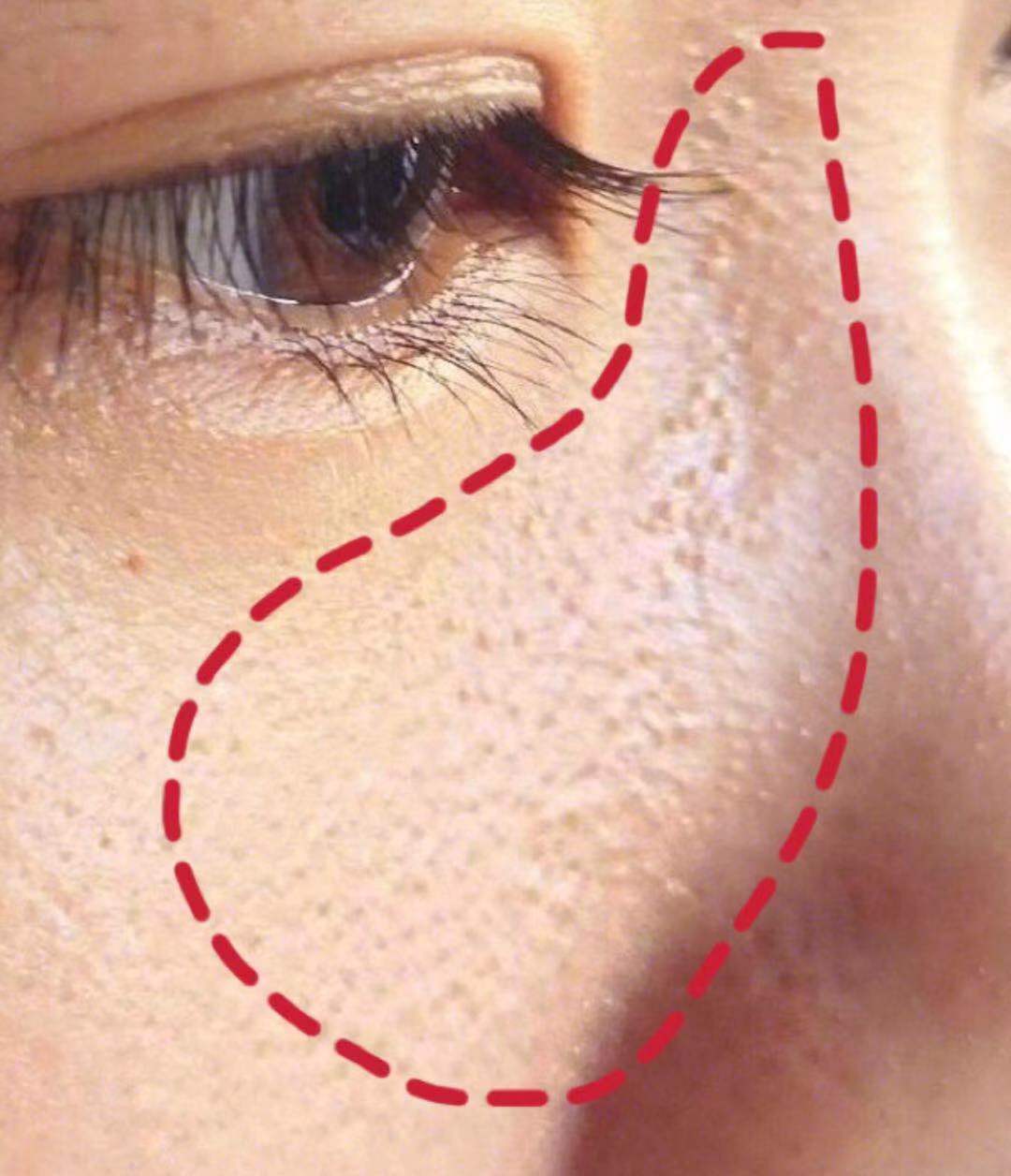 之后会更明显,如果指甲夹得准,就能拽下来一根比较完整的细细的小角栓