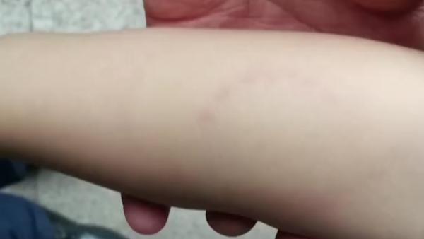 男童被老师咬手臂，托管中心：孩子喜欢打人，只为教育引导