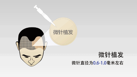 阳江植发技术(珠海植发医院哪家最好)
