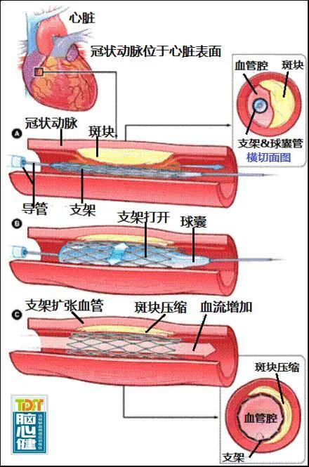 心脏支架植入术后有副作用吗?需要注意什么?