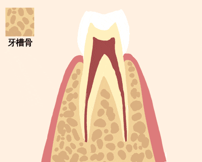 这些牙结石如果没有处理,那么就会感染到我们的牙槽骨,引起牙周袋