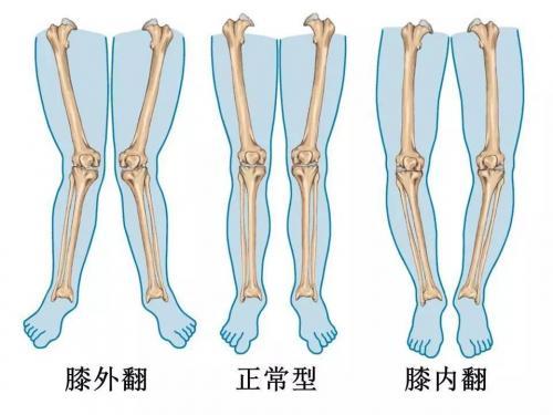 長此以往膝關節會變形,成o形腿或x形腿.